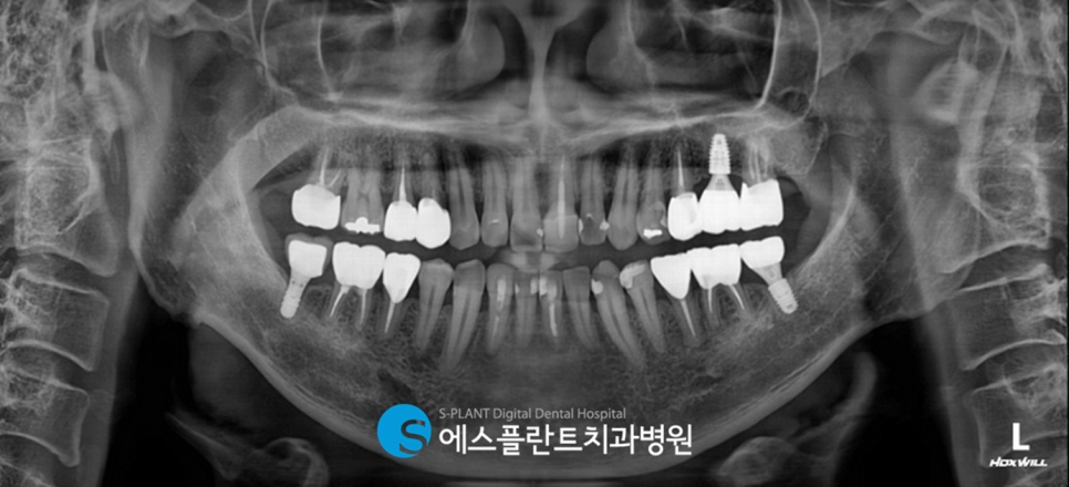 압구정로데오역 발치 후 즉시 임플란트 식립 잘하는 치과, 에스플란트 치과병원 관련 이미지 2