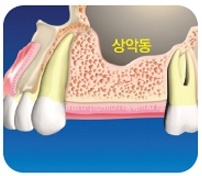 상악동거상술 어려운 만큼 믿을 수 있는 병원에서– 에스플란트치과병원 관련 이미지 2