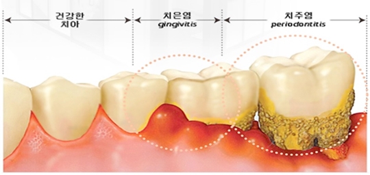 치주질환의 종류, 치은염과 치주염 비교하기 [에스플란트 치과병원] 관련 이미지 1
