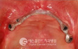 임플란트 틀니 잘하는 곳 "에스플란트치과병원" 관련 이미지 4