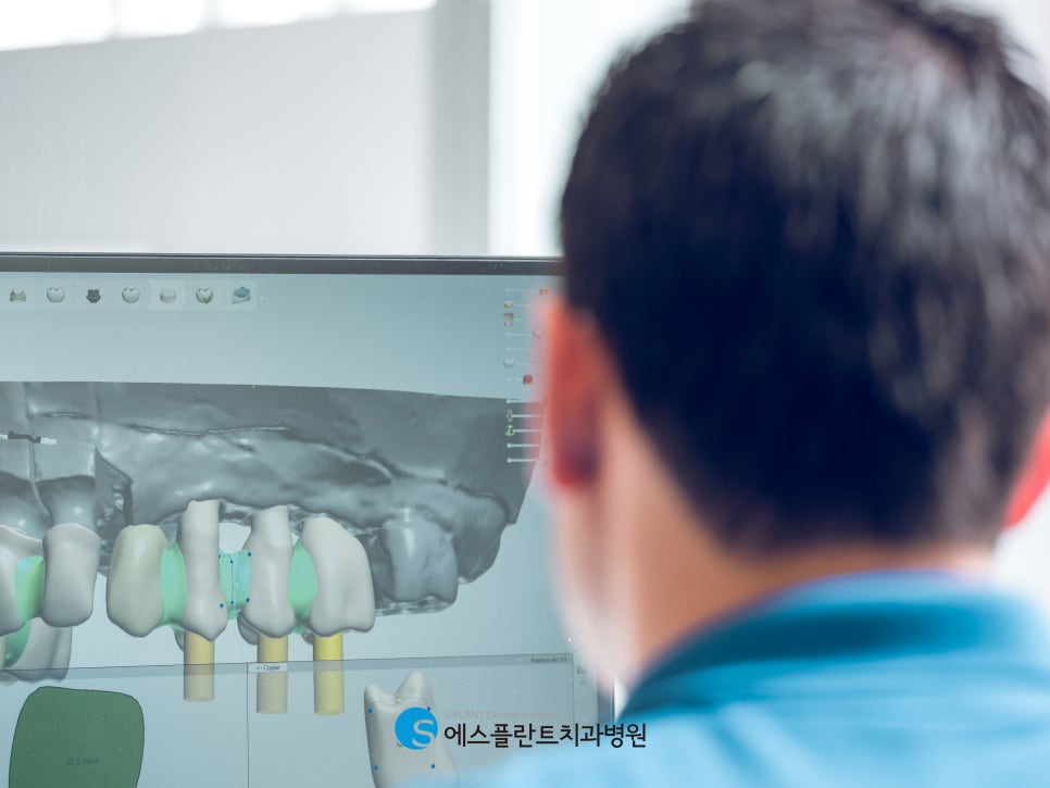 If You're Considering Gangnam Osstem Implant?! At S-Plant Dental Hospital image 4