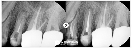 [시린이 치료] 시린 이에 대한 모든 것 2편_시린 이 치료 방법 관련 이미지 4