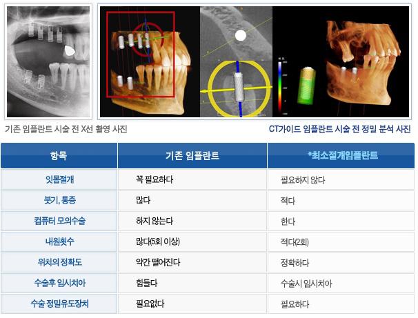 비절개, 무절개임플란트? “에스플란트치과 최소절개임플란트” 관련 이미지 7