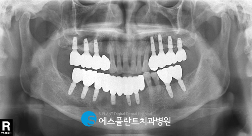 임플란트 잘하는 치과, 에스플란트 치과병원의 임플란트 모의수술과 가이드 제작으로 안전하게 관련 이미지 8