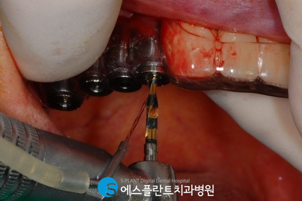 어금니임플란트로 건강한 식생활을 유지하세요! 관련 이미지 5
