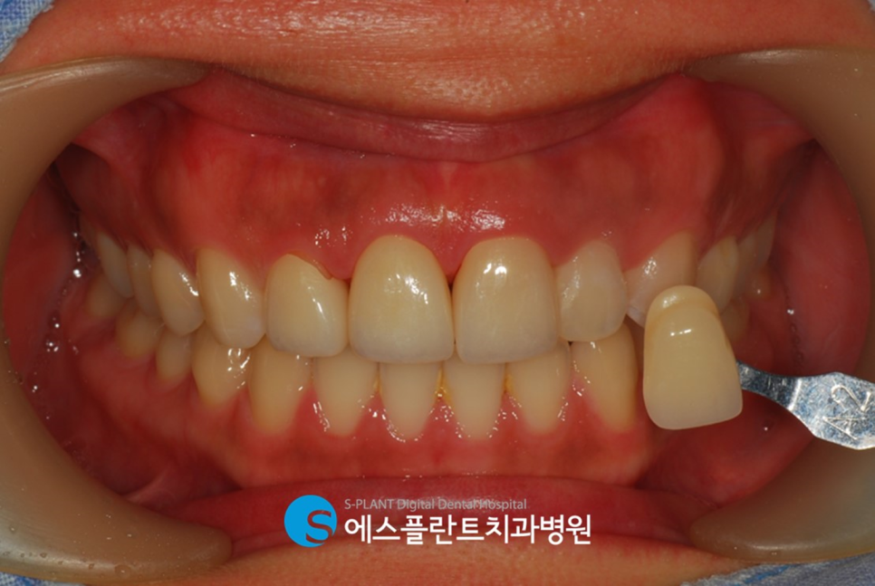 치아외상으로 인한 깨지고 부러진 치아, 강남 에스플란트치과병원에서 자연스럽게! 관련 이미지 6