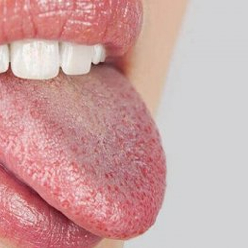 입냄새 나는 이유 무엇일까요? 에스플란트치과병원이 원인과 해결방법 알려드립니다. 관련 이미지 5