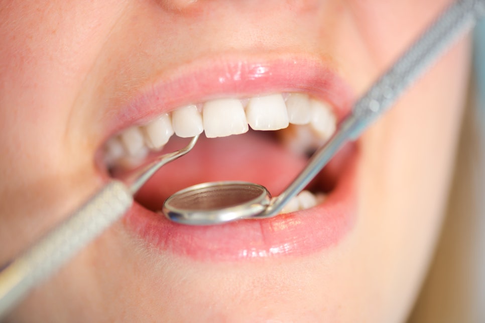 The Perfect Front Tooth Implant Found in Cheongdam Apgujeong Rodeo image 2