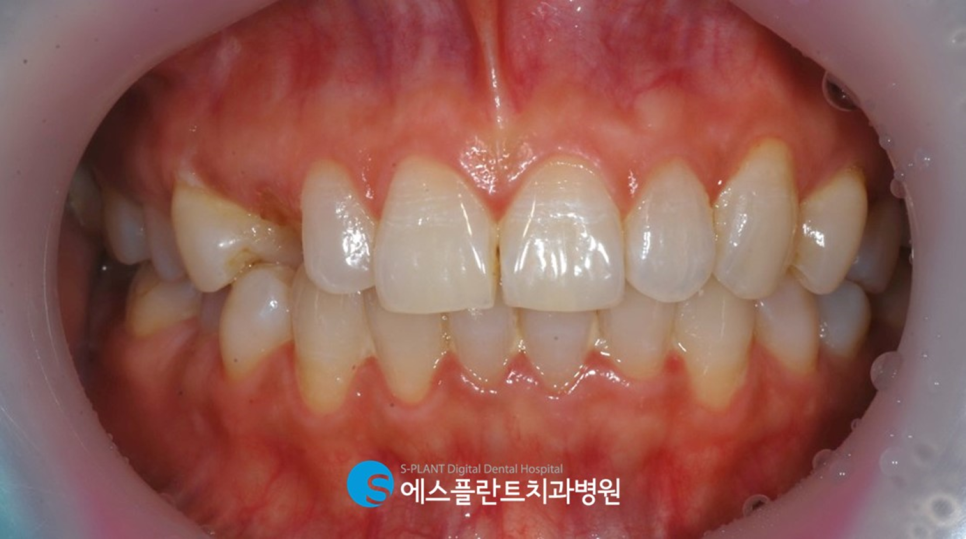 강남 임플란트 잘하는 곳, 에스플란트치과병원 송곳니 견치 임플란트 어떻게 하나요?! 관련 이미지 2