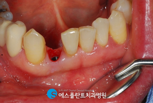 웃을 때 잘 보이는 전치부!하악 전치부 임플란트 치료 사례입니다. 관련 이미지 2