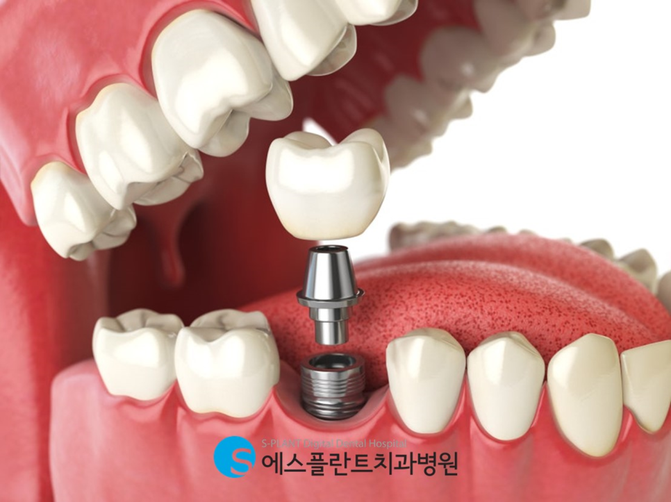 Why Is Apgujeong Full-Mouth Implant Treatment Recommended at Esplant Dental Clinic?! image 2