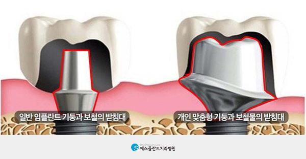 골다공증 있다면,임플란트 시술전 체크사항 관련 이미지 5