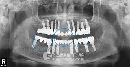 임플란트 브릿지, 임플란트 브릿지 비용 관련 이미지 3