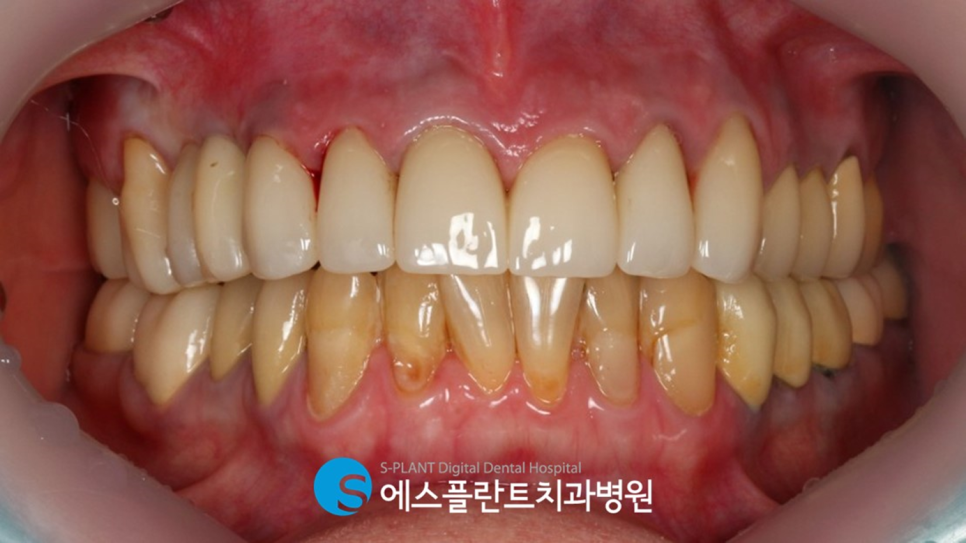 기능성과 심미성 모두 고려한 전치부 지르코니아 심미보철은 청담 에스플란트치과병원에서 관련 이미지 5