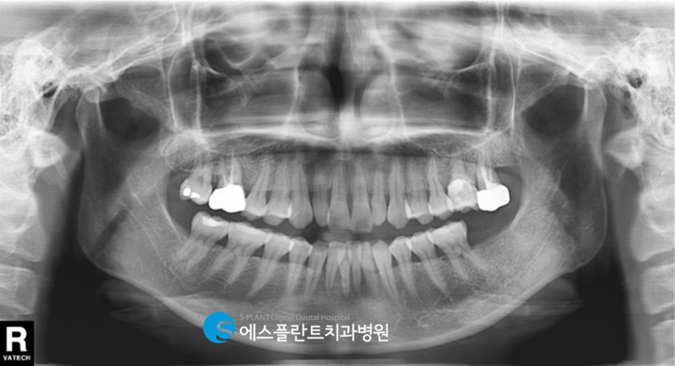뻐 폭이 좁은 아래 앞니 임플란트 잘하는 치과, 강남 에스플란트치과병원 관련 이미지 1