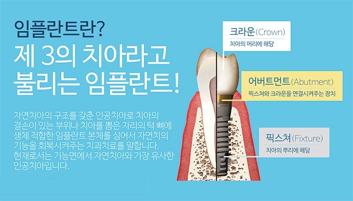 임플란트 시술시 중요포인트 꼭 확인하세요. 관련 이미지 2