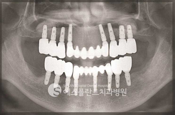 무치악환자,전악임플란트 통해 새로운삶 얻어 관련 이미지 12