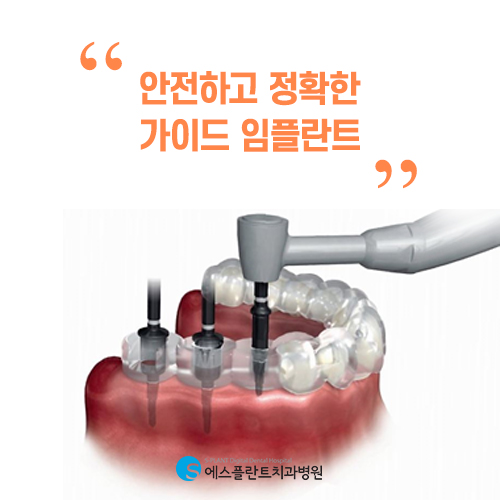 에스플란트 치과병원의 빠르고 정확한 가이드 임플란트 관련 이미지 3