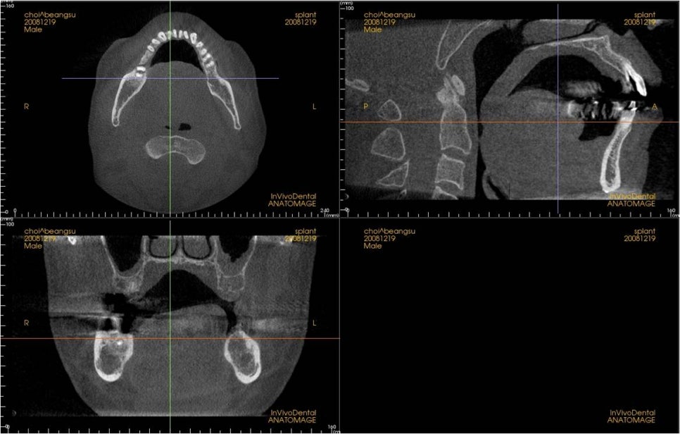 시간이 없어서 임플란트 수술을 미뤄오셨다면, 에스플란트 치과의 즉시기능 임플란트! 관련 이미지 7