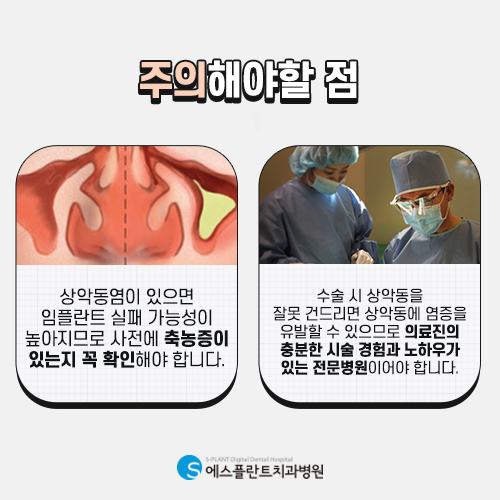 상악동 거상술 임플란트 주의사항 [에스플란트 치과병원] 관련 이미지 4