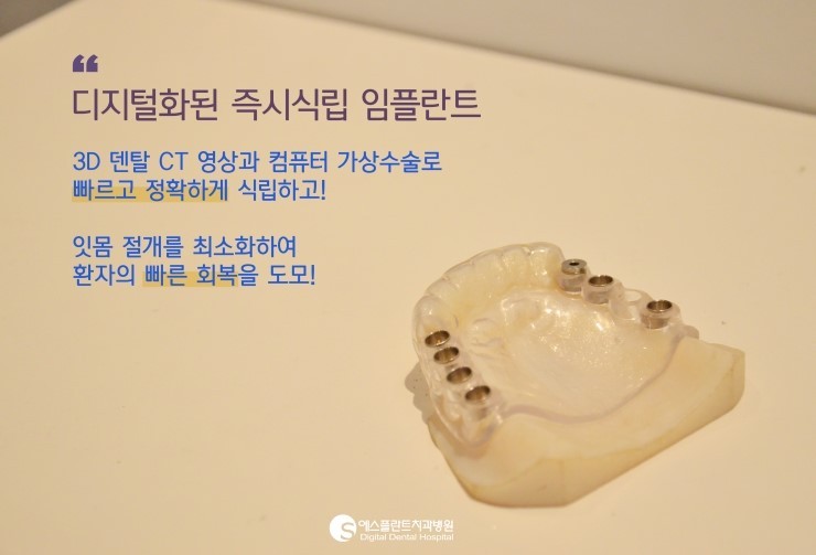 [즉시식립임플란트] 에스플란트치과병원 이정택 원장이 추천하는 즉시 식립 임플란트! 관련 이미지 1