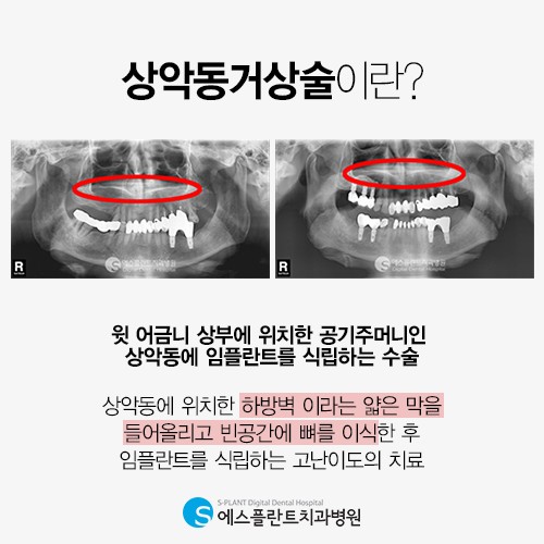 상악동거상술 의료진의 수준이 결과를 결정해 [에스플란트치과병원] 관련 이미지 2