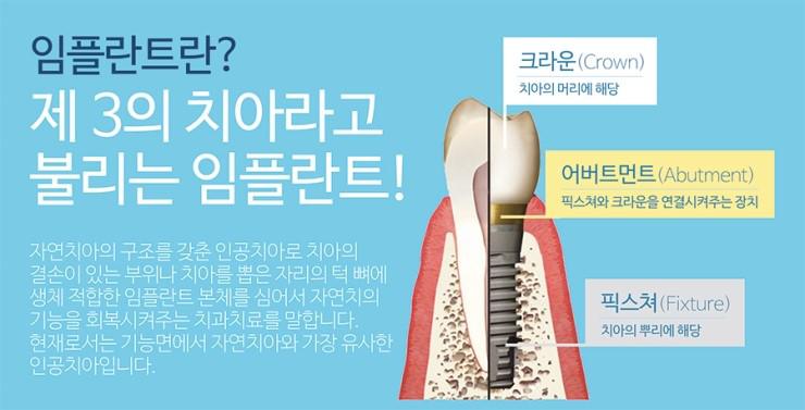 임플란트를더욱튼튼하고오래사용하기위한뼈이식과맞춤임플란트 관련 이미지 1