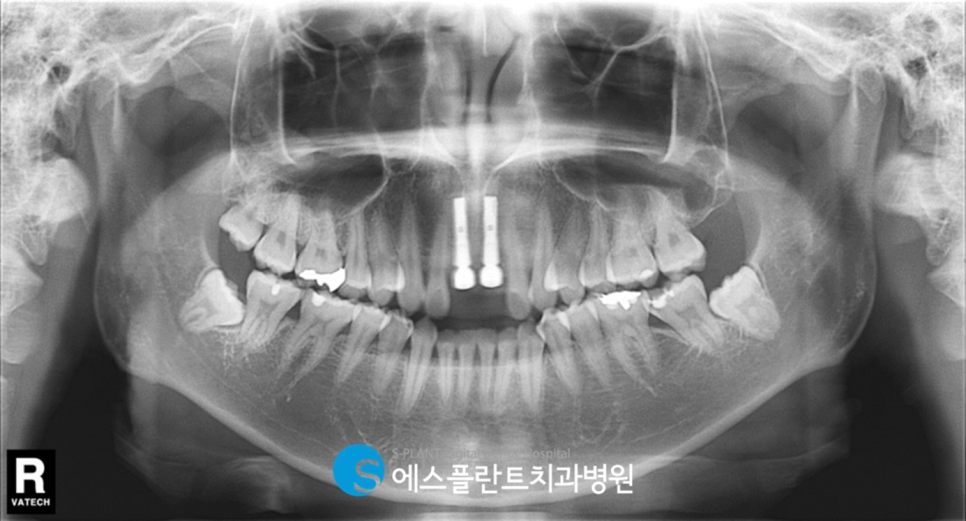 1:1 전담 상담 및 진료를 통한 에스플란트치과의 고난이도 관련 이미지 7