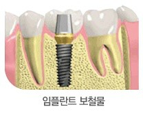 앞니임플란트 가격,앞니임플란트수술후두통있나요 관련 이미지 5