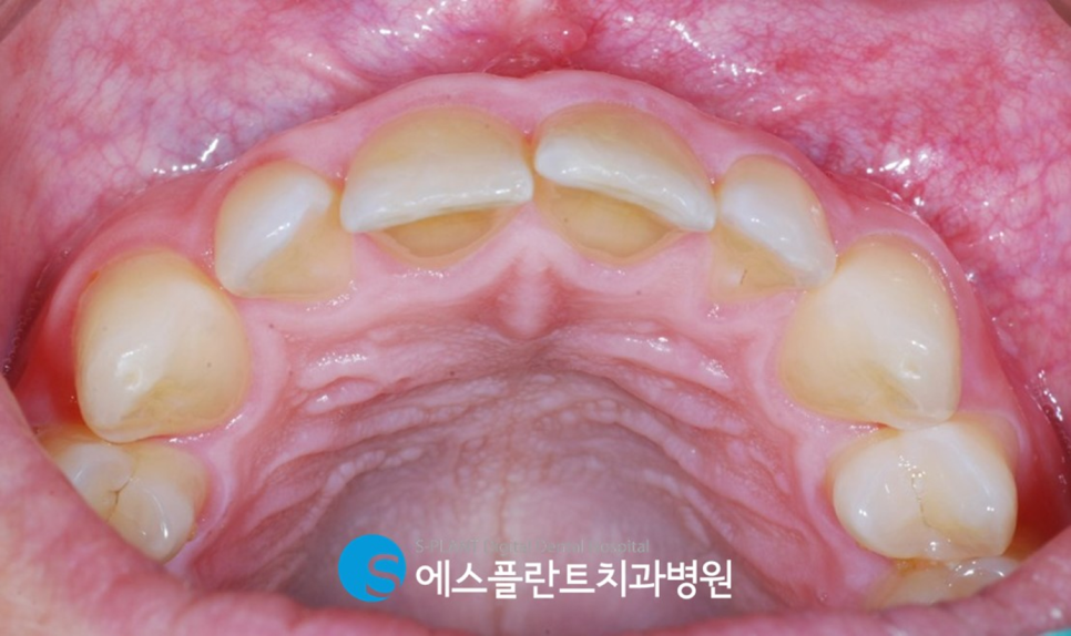 청담 에스플란트치과병원의 전치부 앞니 지르코니아 크라운 심미보철로 치아를 예쁘고 가지런하게 관련 이미지 3
