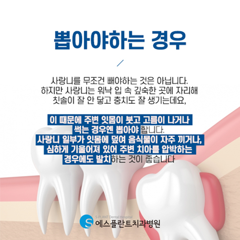 사랑니, 무조건 뽑아야 할까요? <에스플란트치과병원> 관련 이미지 2