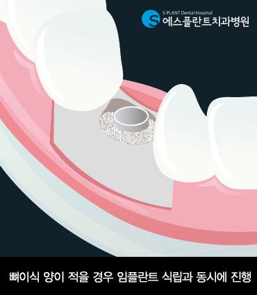 임플란트 시술전후 흡연이 위험한 이유 관련 이미지 4