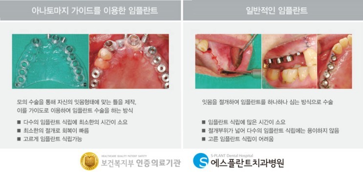 당뇨,고혈압,골다공증등 만성질환, 임플란트 왜 고민해야할까요? 관련 이미지 2
