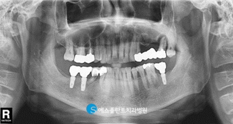에스플란트치과병원의 고난이도 상악동 거상술을 동반한 임플란트 식립 후 10년 경과 케이스 관련 이미지 2