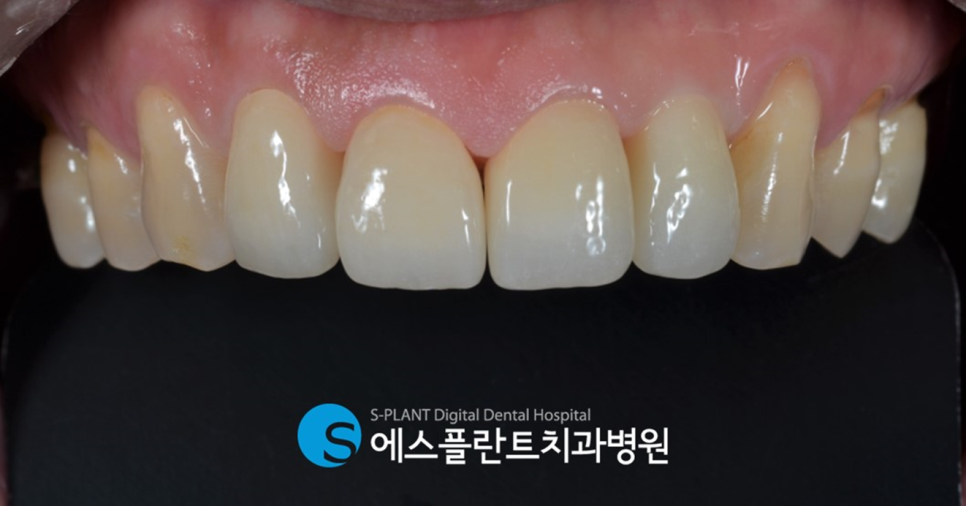 앞니 치아 컴플렉스를 해결하고 싶다면?! 앞구정로데오역 에스플란트치과에서 관련 이미지 5