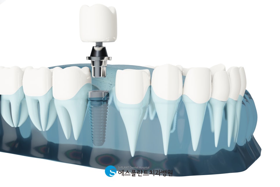 Gangnam Molar Implants: What Should You Consider When Choosing a Dental Clinic?! image 2