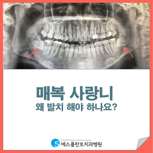 매복 사랑니 발치, 왜 필요할까요? 관련 이미지 2