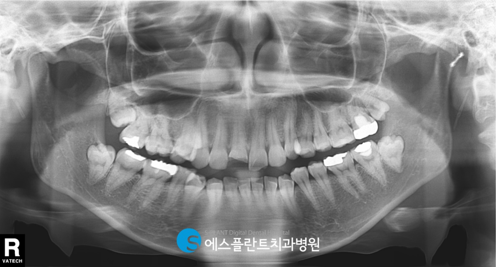 강남 부러진 앞니 임플란트 잘하는 치과, 에스플란트치과병원(전치부 발치 즉시 임플란트 및 당일 임시치아 세팅) 관련 이미지 3