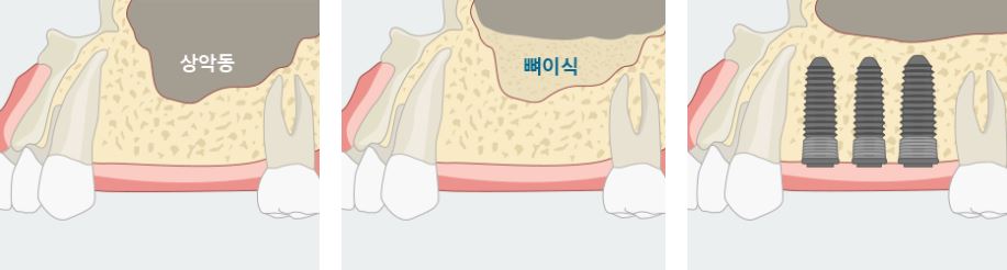 에스플란트 치과병원에서 알려드리는 상악동 거상술 수술 후 주의사항 관련 이미지 2