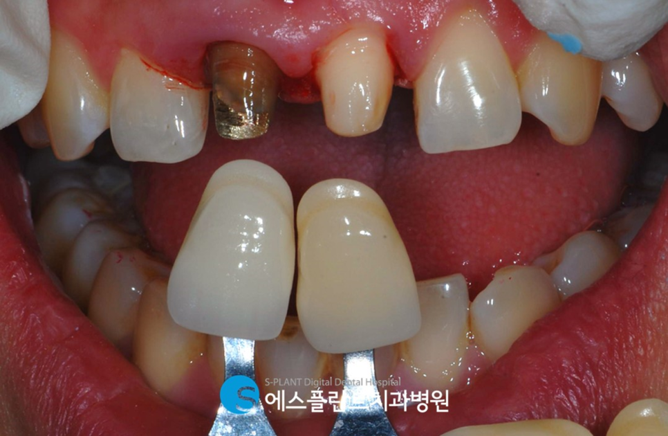 강남 심미보철 잘하는 치과, 에스플란트치과병원에서 알려드리는 오래된 앞니 보철물 교체 관련 이미지 5