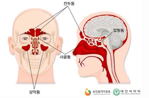 뼈이식임플란트]뼈이식임플란트 후 주의사항, 상악동거상술과정 관련 이미지 5