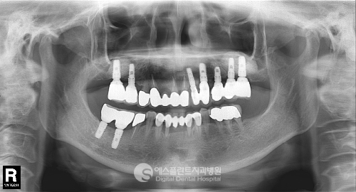 다수의 임플란트 식립도 에스플란트를 믿고 진행하신 환자분의 사례 관련 이미지 6