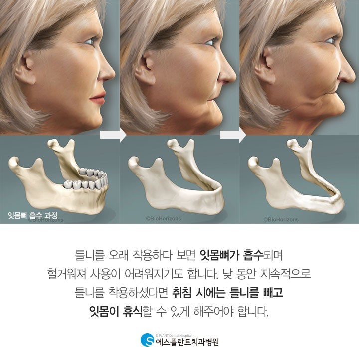 틀니, 잘못 관리하면 구강 문제를 일으킬 수 있습니다. 관련 이미지 6