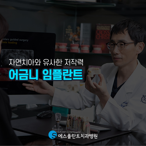 맛있는 음식을 편하게 먹기위해 에스플란트의 어금니 임플란트 관련 이미지 3