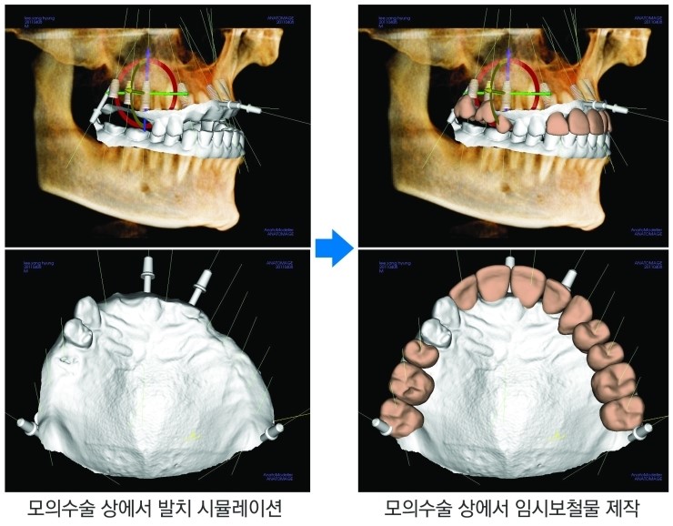 [임플란트 부작용]임플란트 재수술, 시작이 달라야 결과도 다릅니다 관련 이미지 4