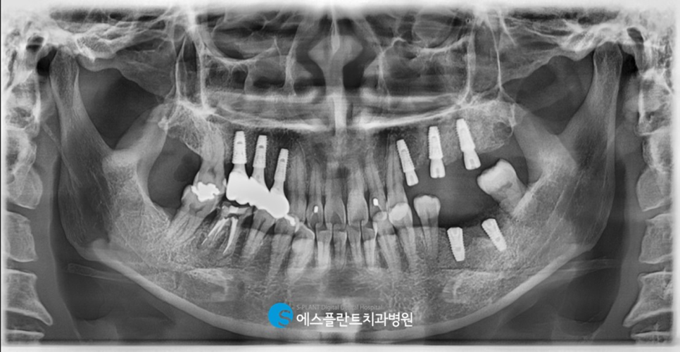 강남치과 에스플란트치과병원의 가이드 임플란트로 만족도 높게! 관련 이미지 5