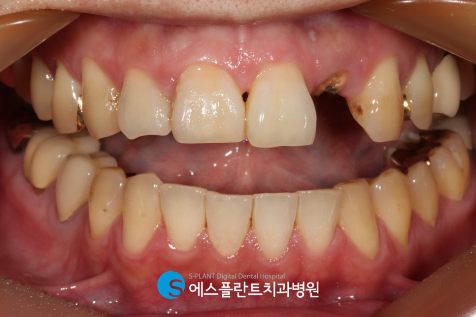 아름다운 미소를 위한 앞니 임플란트는 압구정로데오 에스플란트 치과병원에서 관련 이미지 3
