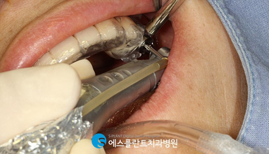 압구정로데오역치과 임플란트 잘하는 치과, 에스플란트 치과병원에서 실제로 사용하는 가이드 임플란트란?! 관련 이미지 6