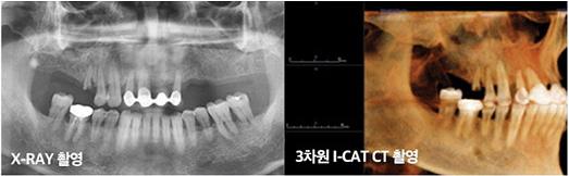 에스플란트치과병원이말하는 가이드임플란트는 &ldquo;진단과 계획이 중요해&rsquo; 관련 이미지 3