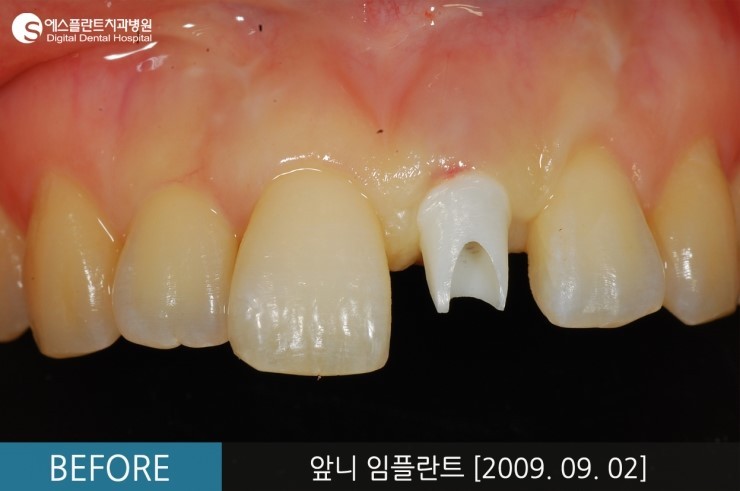 [뼈이식임플란트] 앞니 임플란트, 뼈이식 앞니 임플란트 전후 CASE 관련 이미지 4
